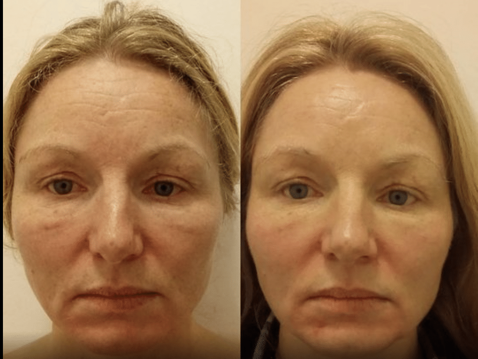 Masaż Kobido Efekty