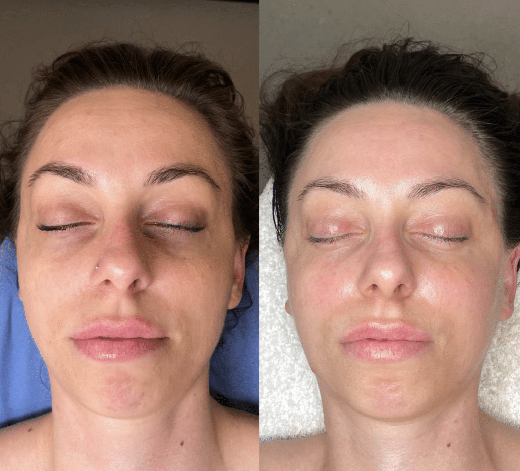 Masaż Kobido - efekty